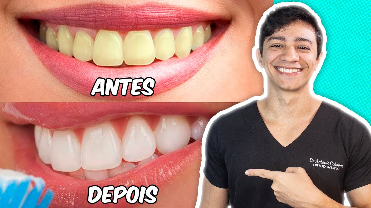 Dentista Revela SEGREDOS de Clareamento Dental que Ninguém Conta + Receita Caseira!