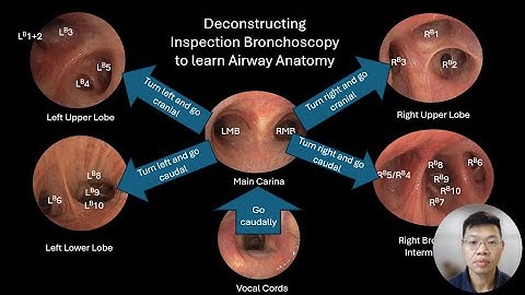 Bronchial Branch Tracing Made Easy?