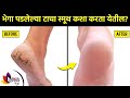       how to get rid of crack heels at home cracked heels treatment