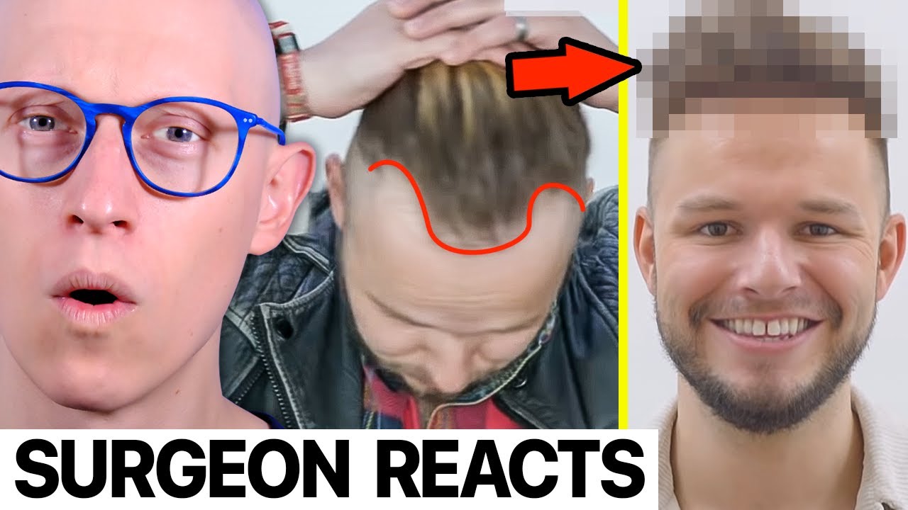 REMARKABLE 6 Months Hair Transplant Before & After | Surgeon Reacts