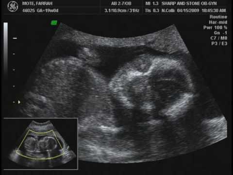 Baby Boy Mote Ultrasound - Part 1