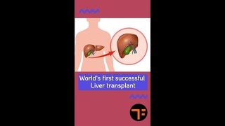 First Successful R Transplant  Factime shorts youtube youtubeshorts facts factime science