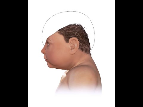 Video: Microcephaly - symptoms, causes and diagnosis of microcephaly