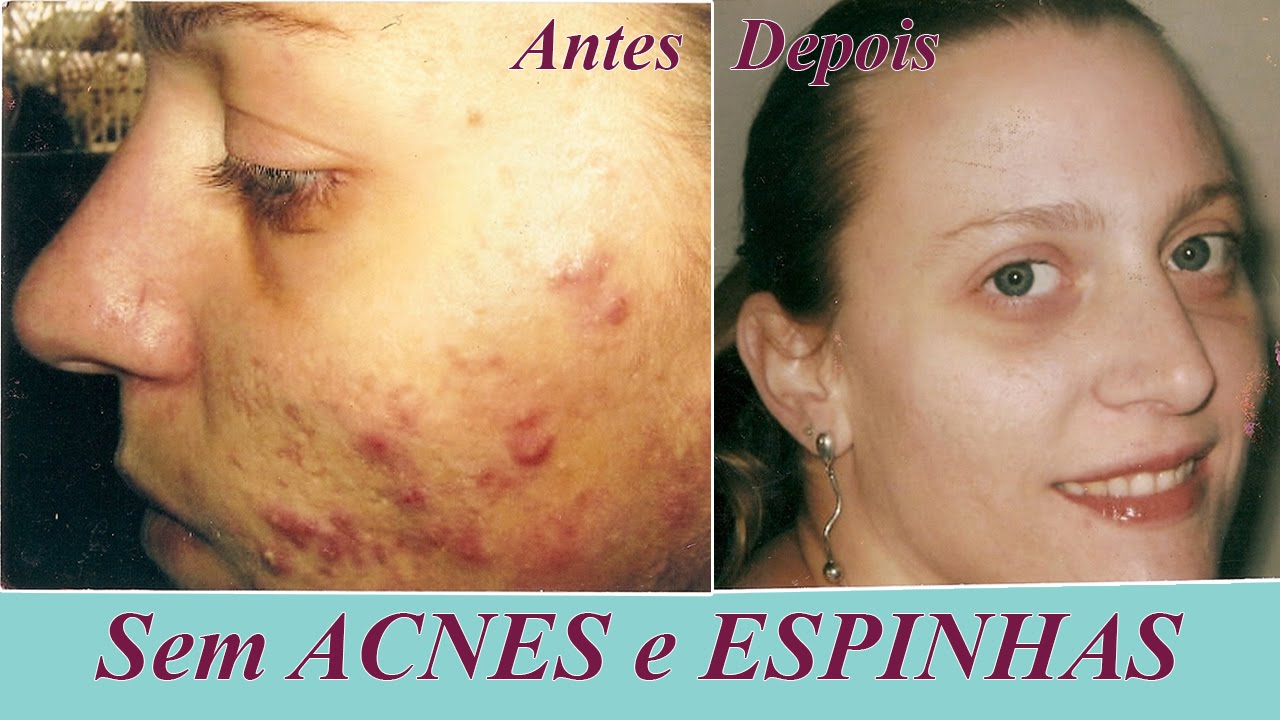 Tratamiento para quitar manchas por acne
