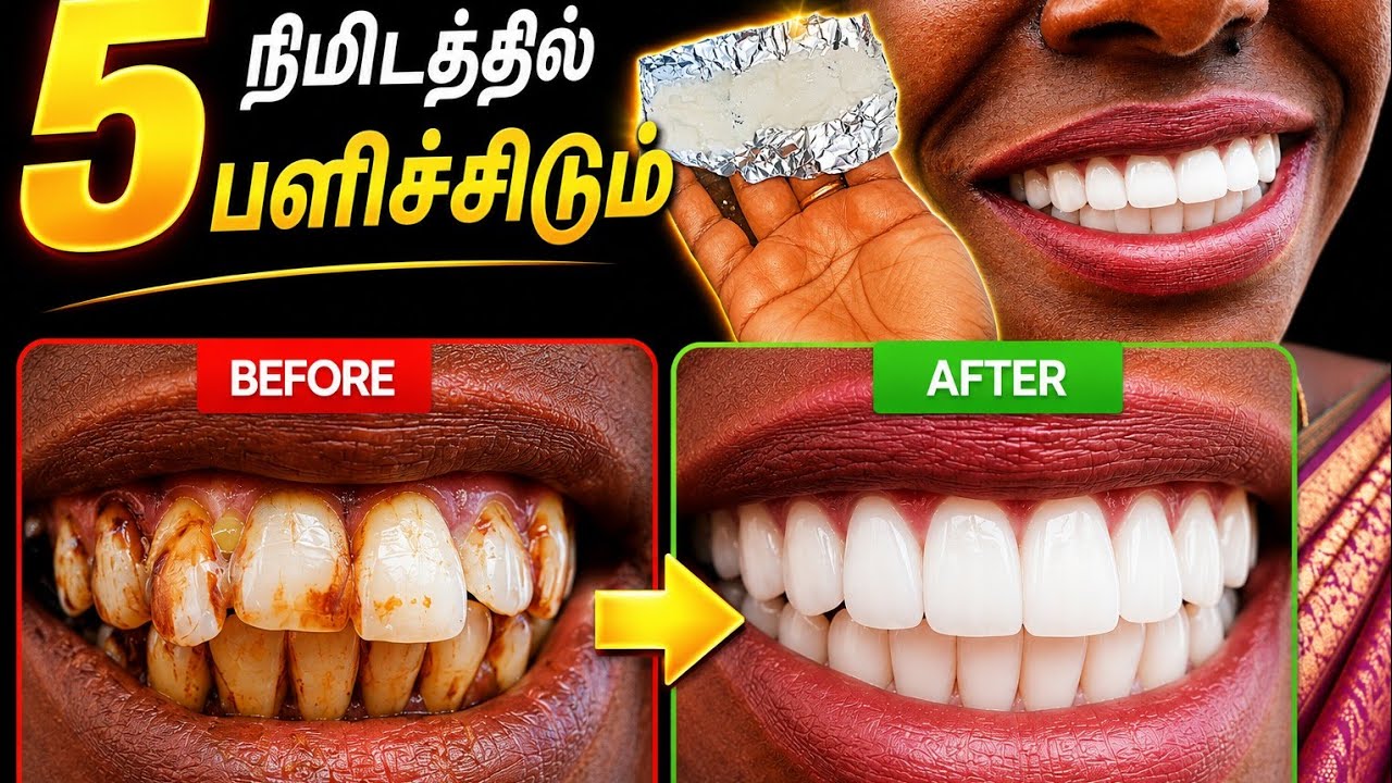 மஞ்சள் பற்கள் 5 நிமிடத்தில் வெண்மையாக்கும் பளிச்சிடும் சீக்ரெட் ! இது தெரியாம போச்சே!teeth whitening