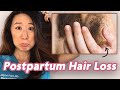 Why is my hair falling out postpartum hair loss explained by dermatologist dr joyce park