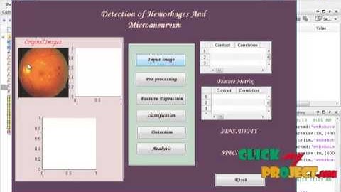 Final Year Projects | Automated Feature Extraction for Early Detection of Diabetic Retinopathy in F