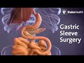 Gastric sleeve surgery  duke health