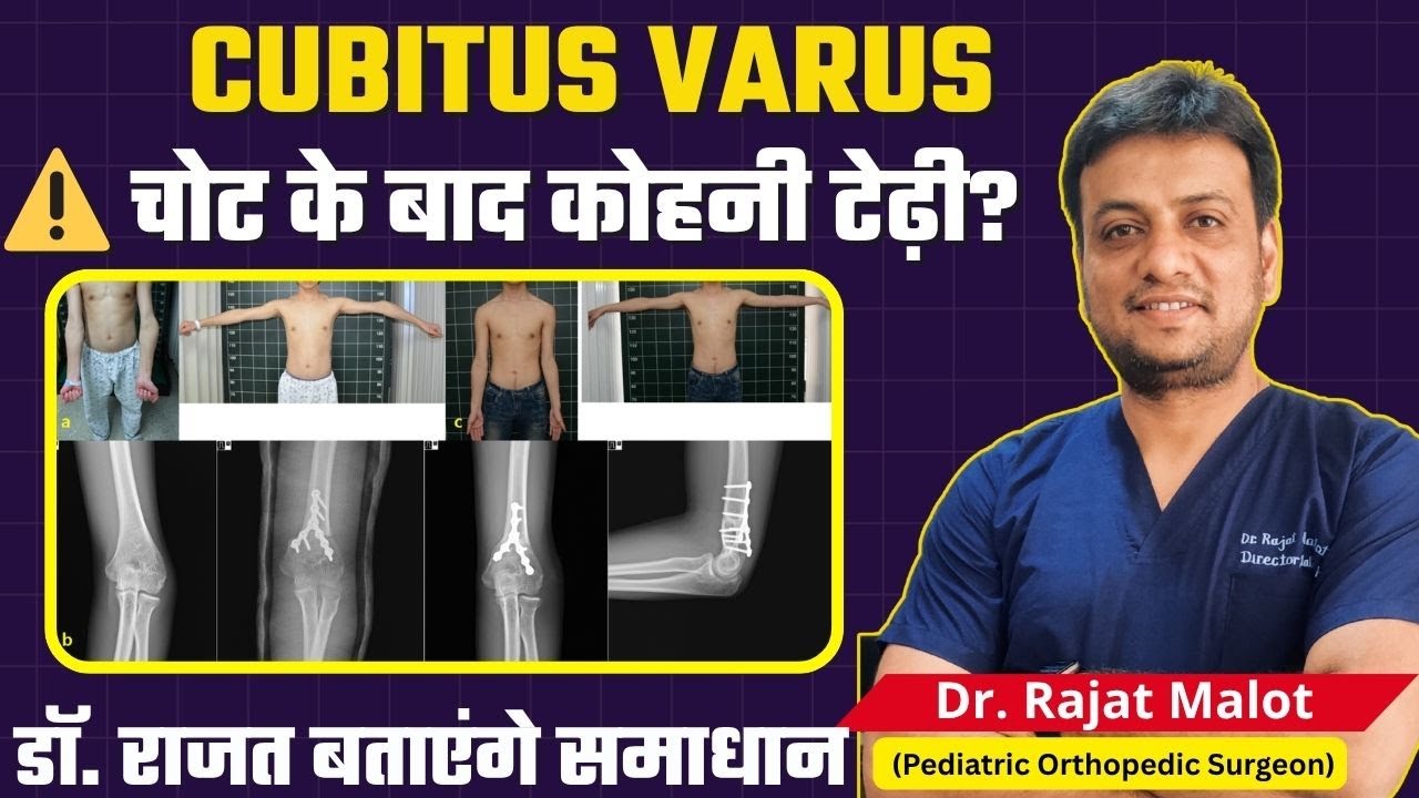 Correction of Cubitus Varus Deformity | कोहनी का टेढ़ापन का कारण और इलाज | Dr Rajat Malot