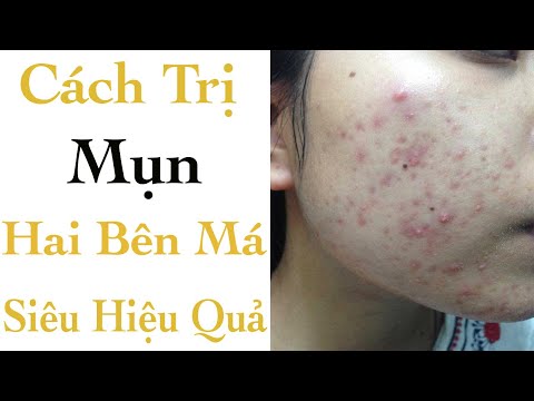 Cách Trị Mụn 2 Bên Má Siêu Hiệu Quả - Mỹ Phẩm SOSENCO