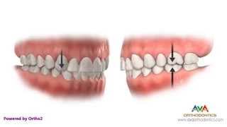 Malocclusion - Class I Crowding