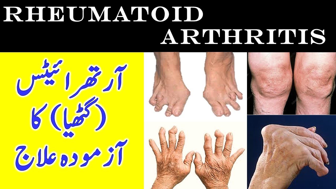 ARTHRITIS TREATMENT RHEUMATOID, آرتھرائیٹس (گٹھیا ) کا بہترین علاج