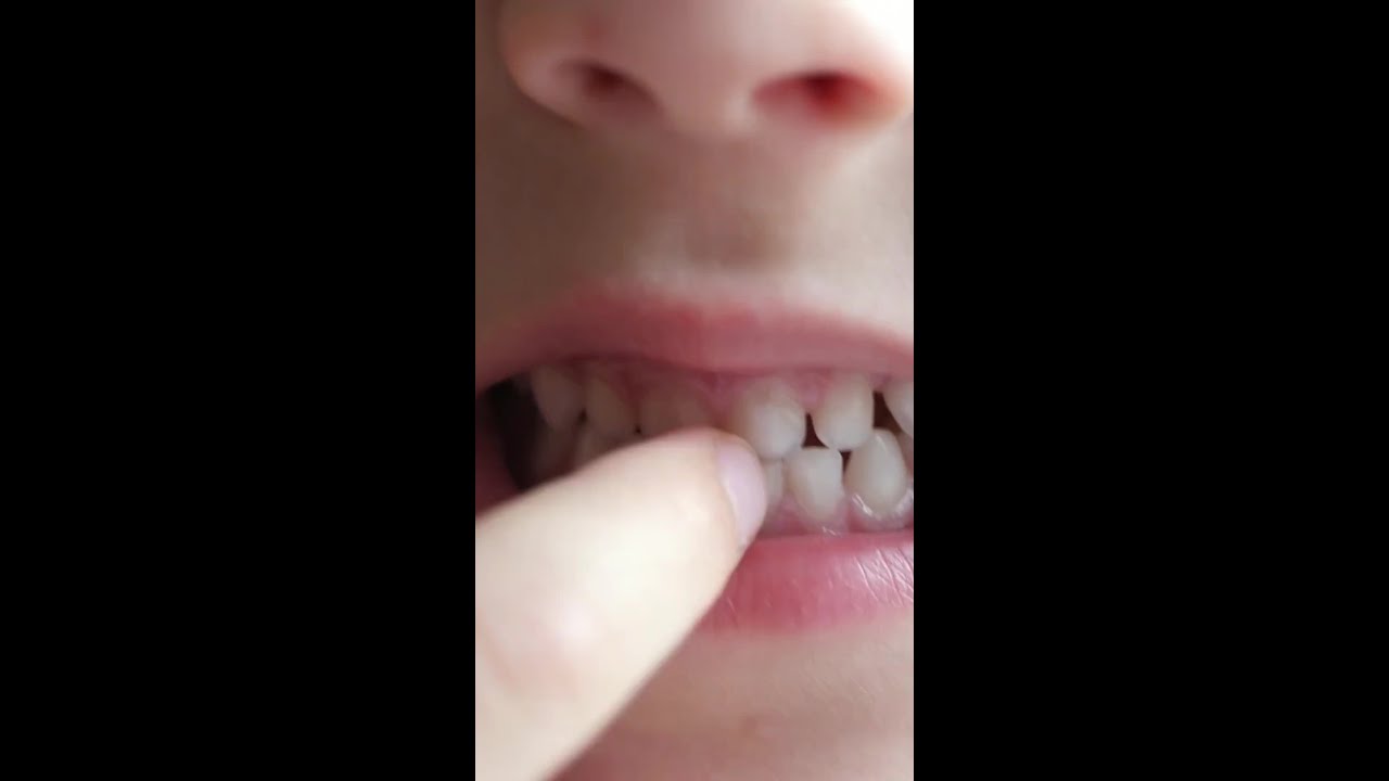 What if Your Child Swallows a Tooth?