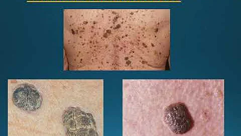 Skin cancer education - DayDayNews