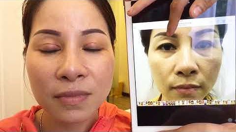 Cùng Nhận Xét Nếp Mí Mới Sau 7 Ngày Cắt Mí Tại Dr.Hải Lê.