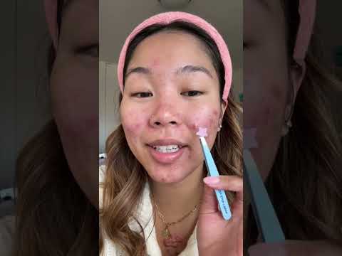 Do The Viral Star Pimple Patches Actually Work Or Are They Just Cute Pimplepatch Starpimplepatch
