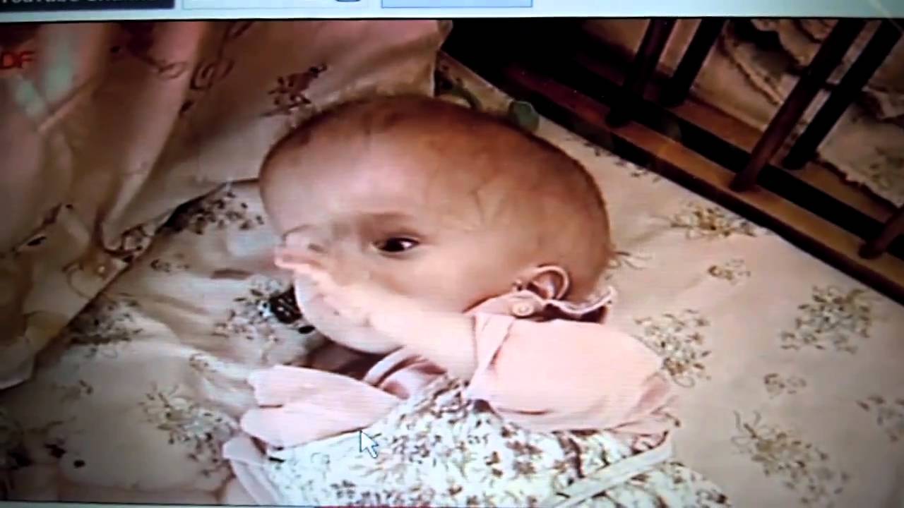 チェルノブイリ原発事故の奇形児 Youtube