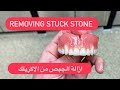 Removing stuck stone from acrylic-طريقة ازالة الجبصين من الاكريلك #WAXBAE