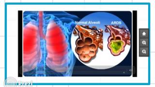 Respiratory Distress and Abdominal Distention