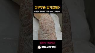 #피부무좀발각질  #무좀갈각질  #일산발각질 #발각질제거  하얗게 일어난 각질들이 여기저기 떨어질때마다 보기 싫고 찝찝했을텐데 제대로 관리받고 시원해진 발바닥