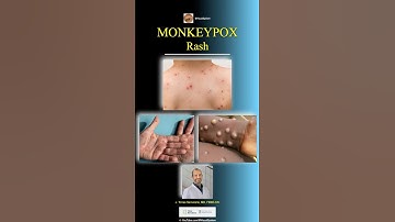Erupción Cútanea por la Viruela del Mono || Monkeypox Rash || Mpox Rash || #monkeypox #mpoxvirus