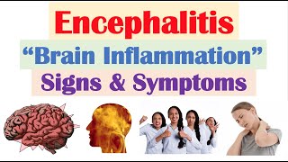 Encephalitis (“Brain Inflammation”) Signs and Symptoms (& Why They Occur)