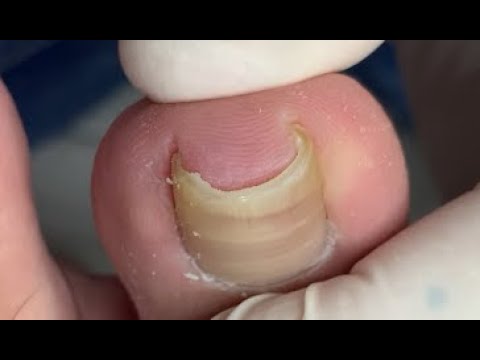 Quick fix for curved nail