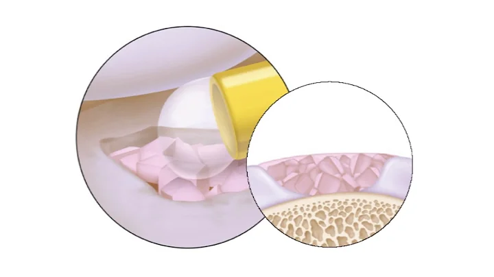 Denovo Natural Tissue Grafting