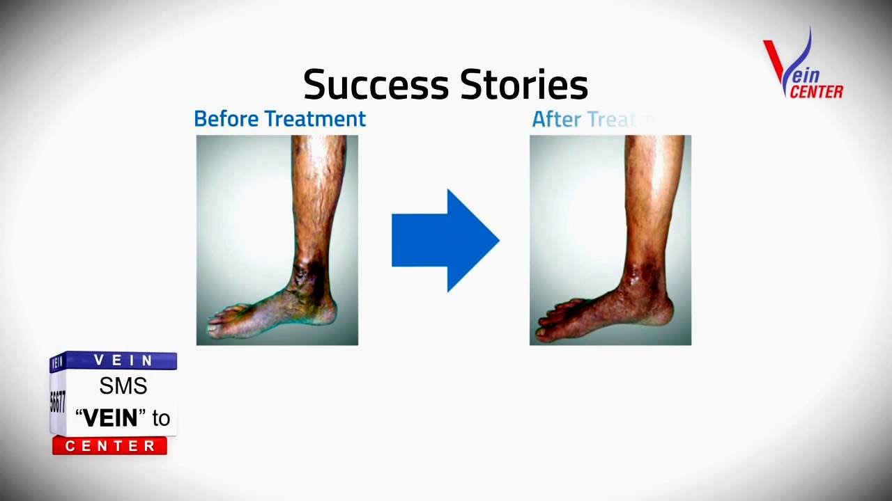 how i cured my varicose veins how i cured my varicose veins