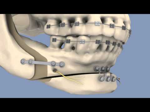 BSSO & Osseous Genioplasty