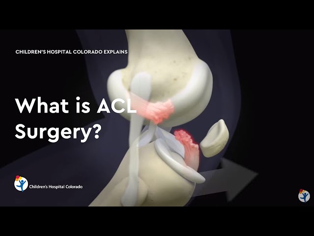 Understand Knee Ligament Injuries (ACL, PCL, MCL, LCL) - 3D animation 