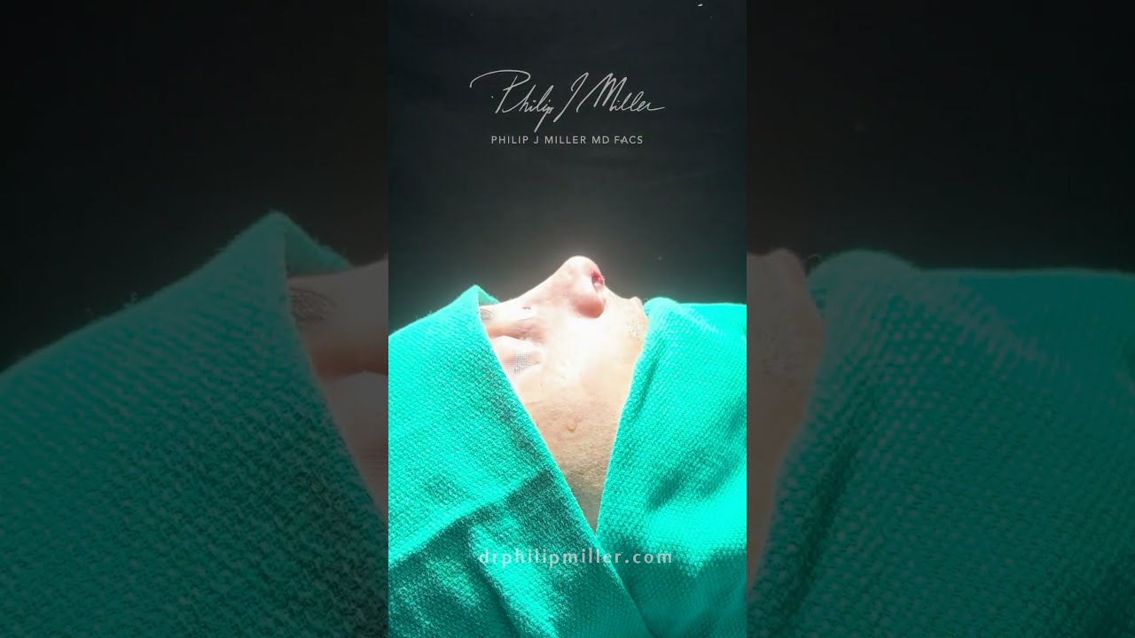 Incredible Rhinoplasty Transformation!
