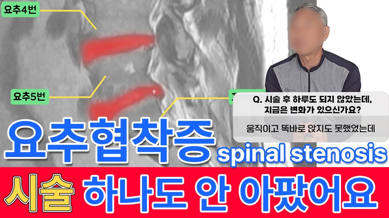 [마디마디신경외과] 심한 추간공 요추협착증 요추내시경 신경성형술로 완치한 사연 - YouTube