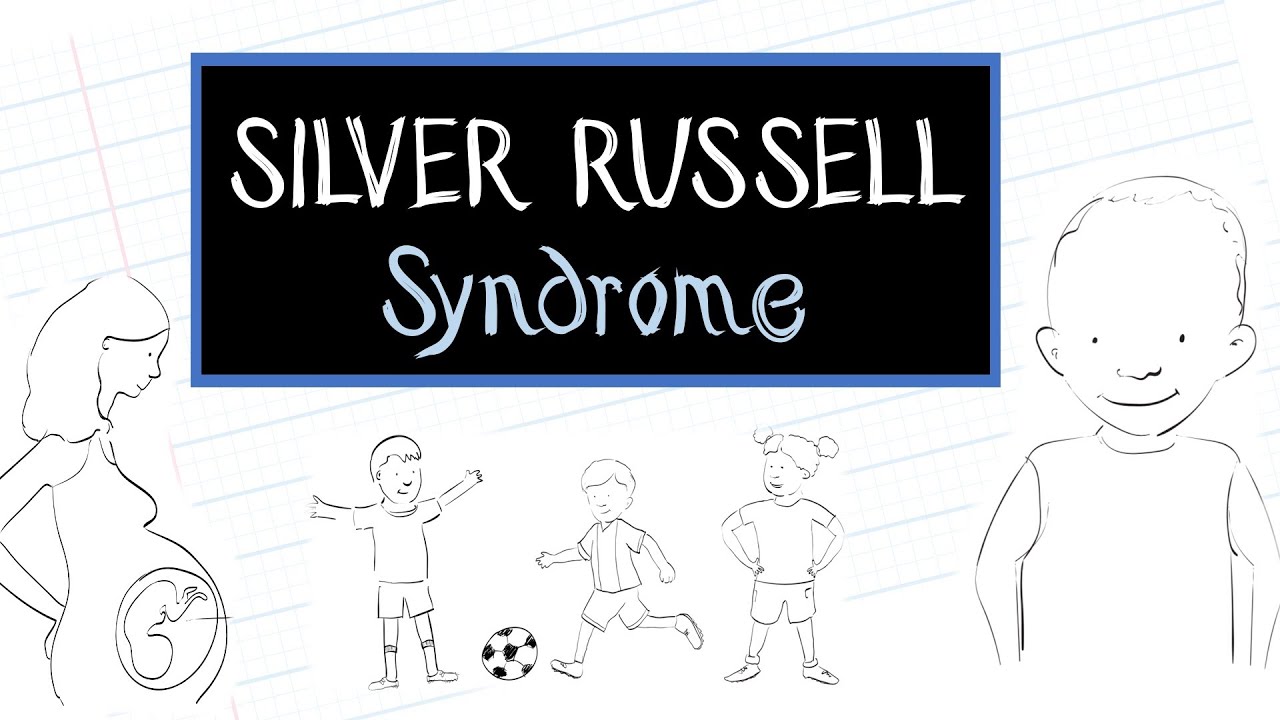 Russell Silver Syndrome Growth Chart