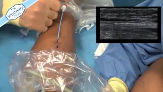 EVLT Endovenous Laser Treatment of Varicose Veins - Live case by Mr Barrie Price