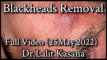 Blackhead Removal by Dr.Lalit Kasana / New Full Video (25 May 2022)