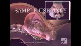 Persalinan - Persalinan Normal Vaginal