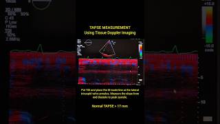 TAPSE MEASUREMENT #echocardiography #echo