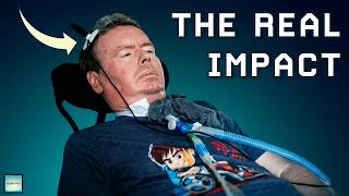 The Real Impact of Neuralink for Paralyzed Patients