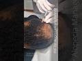 PRF for Alopecia management #alopecia #womenhairloss