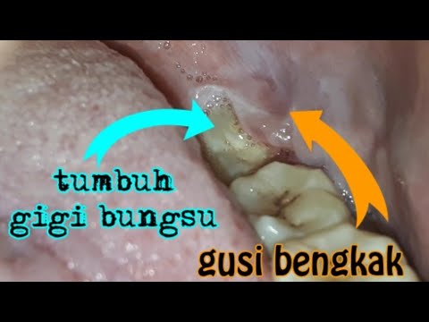 DR OZ - Jangan Anggap Remeh Sakit Gigi (15/9/18) Part 4. 