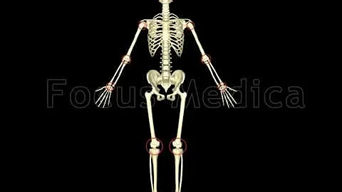 Rheumatoid arthritis - Animated Atlas