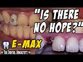 Restoring a heavily fractured tooth with a post and emax crown c18 4k