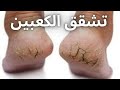 تشقق الكعبين تشقق الكعب علاج تشقق الكعبين علاج خشونة وتشقق الكعبين تشققات الكعبين تشققات الكعب