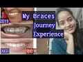 My Braces Journey Experience ,Metal Braces,2 year Braces story,Happy with new smile||Braces||