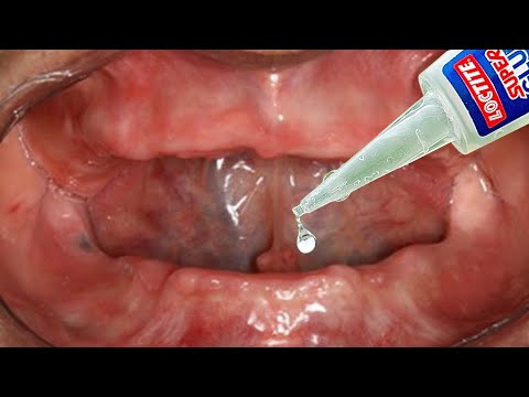 Video: ¿Se pueden hacer prótesis dentales sin impresión?