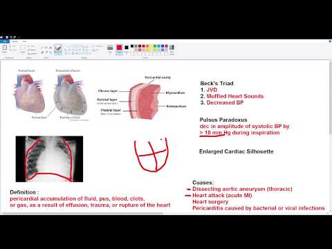 Video: Cardiac Tamponade: Syyt, Oireet Ja Hoito