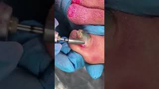 A complicated case of toenail fungus? fungus toenail fungustreatment shorts