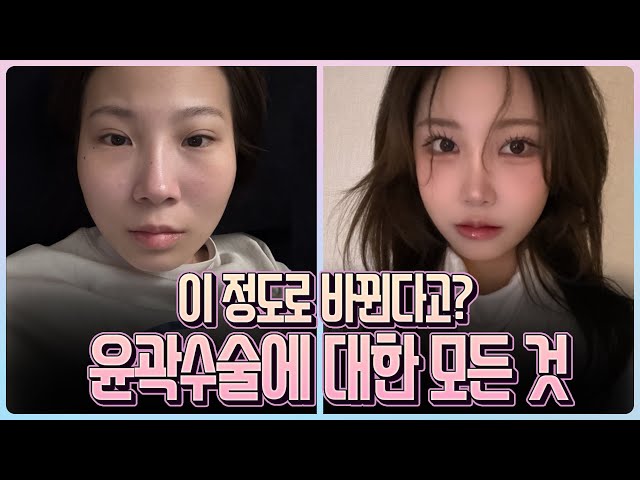 윤곽수술에 대한 편견🤔 오늘 깨드리겠습니다✨