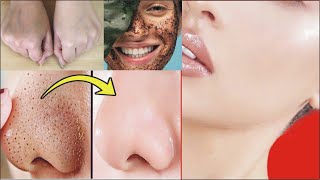 चेहरे के Blackheads, Whiteheads, Open Pores व दाग धब्बों से 100% छुटकारा पाएं | DIY Face Scrub/Mask